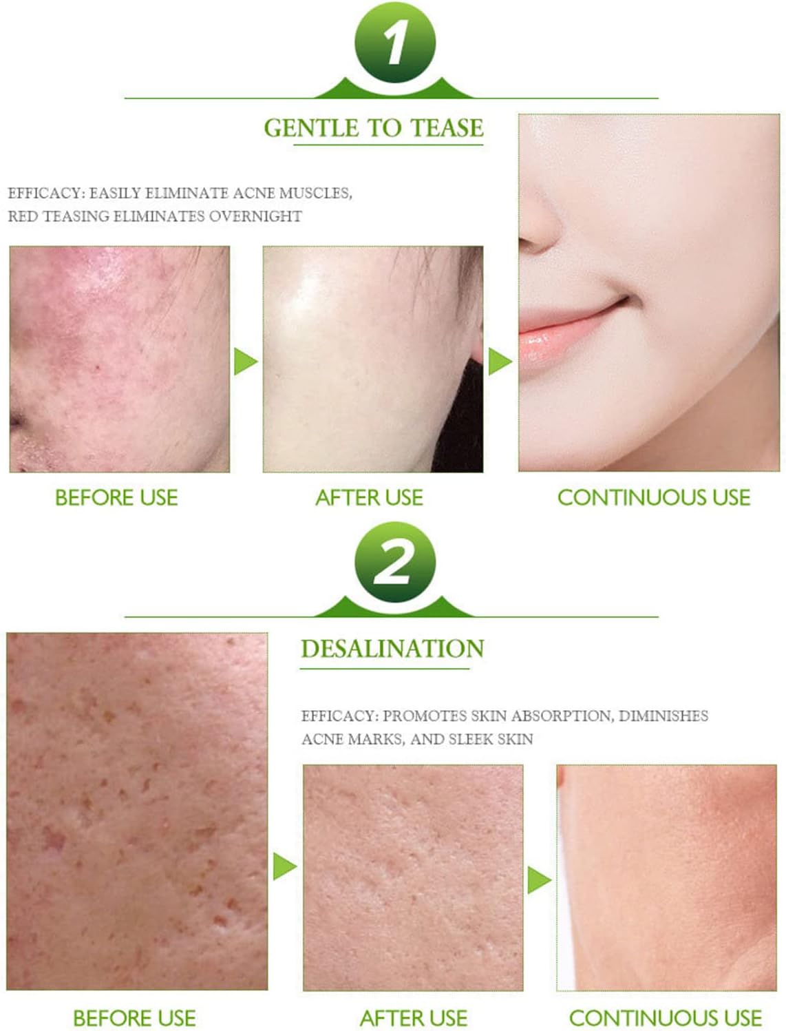 AICHUN BEAUTY Face Acne Cleaning Cream Skin Care Remove Repair Comedone Pimple Acne Face Acne Cream 30ml