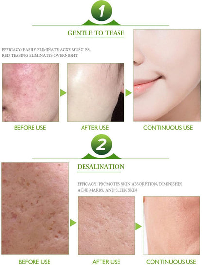 AICHUN BEAUTY Face Acne Cleaning Cream Skin Care Remove Repair Comedone Pimple Acne Face Acne Cream 30ml