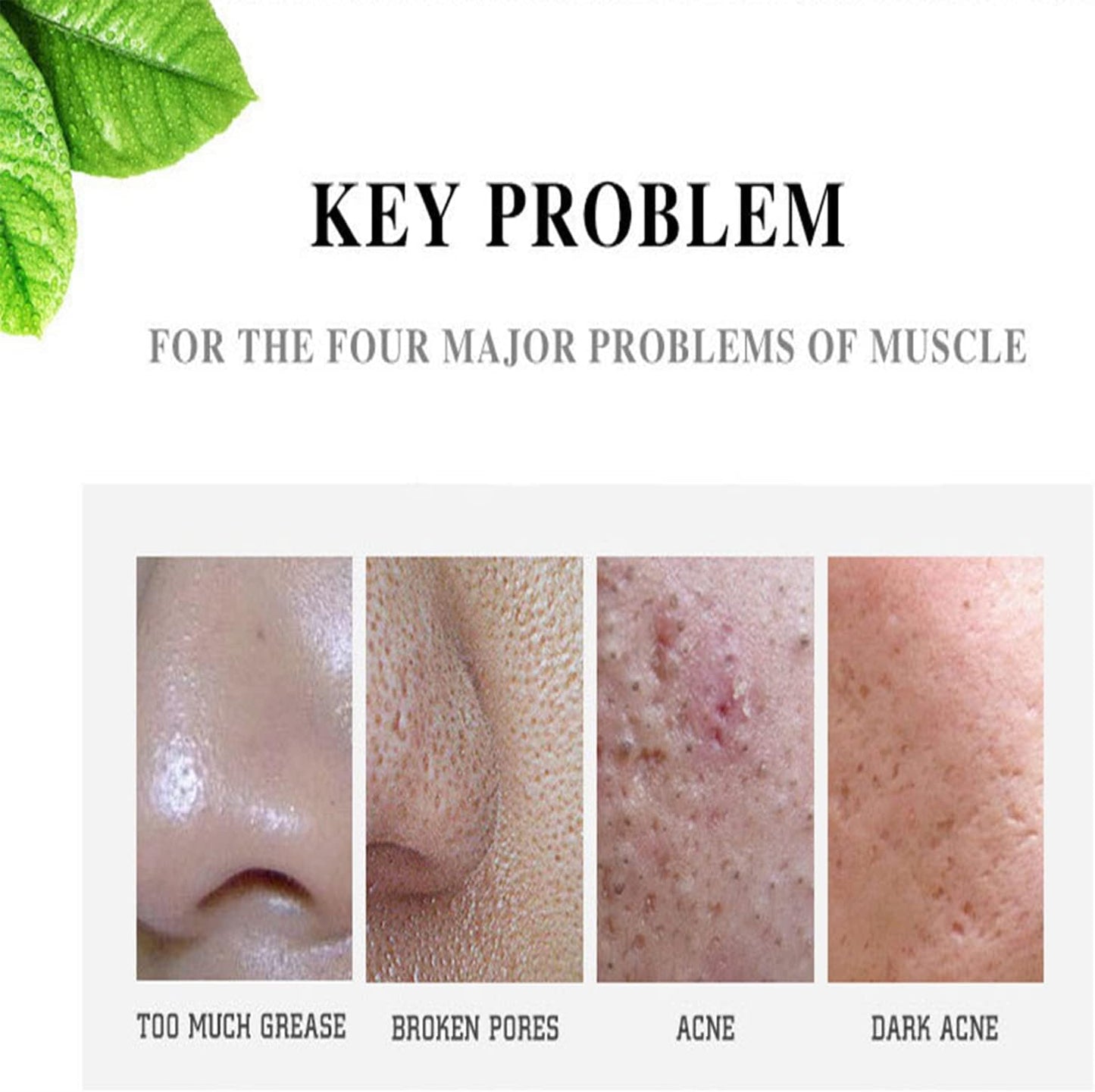 AICHUN BEAUTY Face Acne Cleaning Cream Skin Care Remove Repair Comedone Pimple Acne Face Acne Cream 30ml